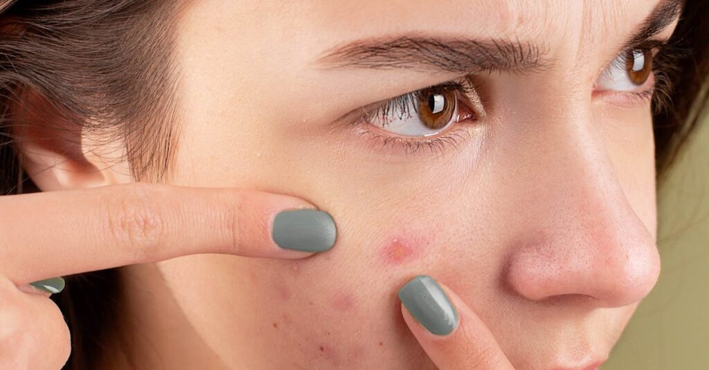 Close-up of a young woman treating her acne-prone skin.